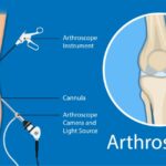 arthroscopy-procedure