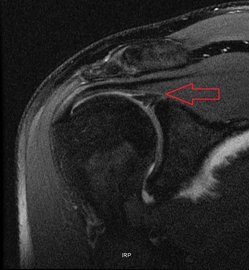 slap lesion1